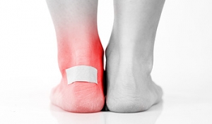 Blisters on the Feet Can Protect Damaged Skin
