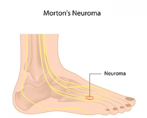 Symptoms of Morton’s Neuroma