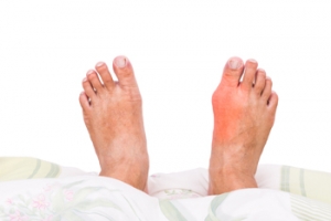 Causes of Gout
