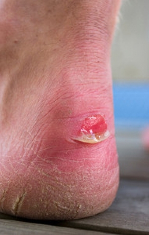 Why Do Blisters Develop?