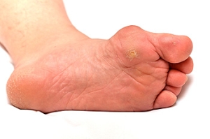 What Causes a Bunion to Develop?