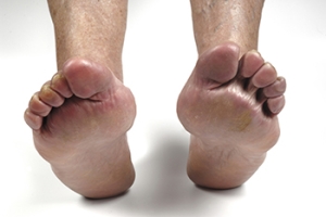 Ways Arthritis Affects the Toes