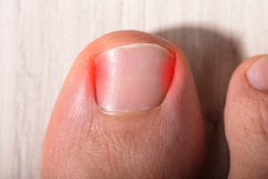 Causes and a Possible Solution for Ingrown Toenails