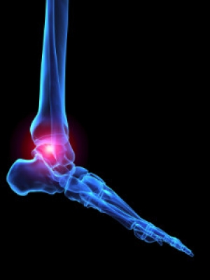 What Causes Ankle Arthritis?