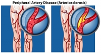 Risk Factors and Symptoms of Peripheral Artery Disease