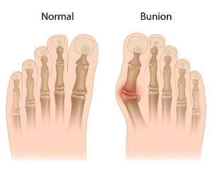 Bunions and How They are Treated