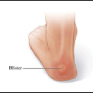 A New Bunion Treatment