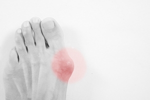 Possible Causes of Bunions