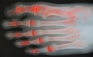 Tarsal Tunnel Syndrome and Rheumatoid Arthritis