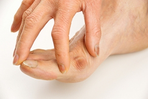Corns and Bunions May Produce Foot Pain