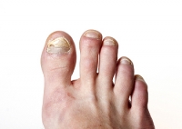 Signs You May have a Fungal Nail Infection