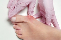 Bunions Are a Common Foot Condition