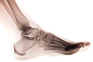 Biomechanical abnormalities of the foot