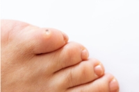 Causes and Common Locations of Seed Corns