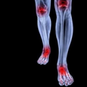 Reducing Inflammation in Arthritis