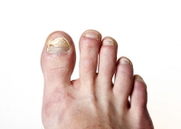 Signs That You May Have Toenail Fungus