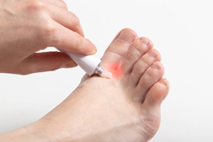 Symptoms of Athlete’s Foot