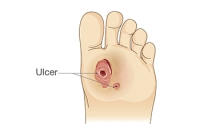 The Seriousness of a Diabetic Foot Ulcer
