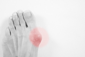 What Causes Bunions?