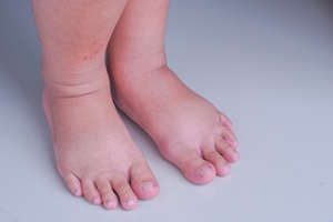 Swollen Feet and Diabetes May Be Connected