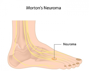 What is Morton’s Neuroma?