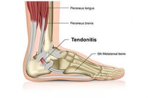 Signs of an Achilles Tendon Rupture
