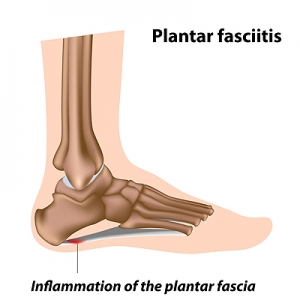 Heel Pain May Be Indicative of Plantar Fasciitis
