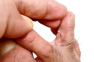 Athlete’s Foot and How It Is Treated