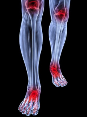 Foot Conditions That May Occur as a Result of Rheumatoid Arthritis
