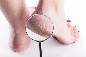 Possible Causes of Cracked Heels