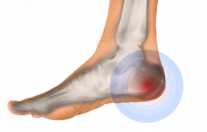 How to Diagnosis Plantar Fasciitis