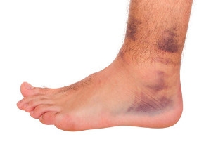 Two Types of Ankle Sprains