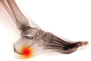 What Are Heel Spurs?