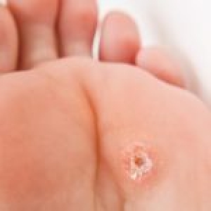 Plantar Warts