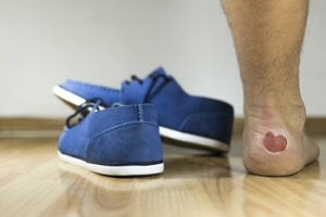 Causes of Blisters