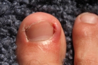 Preventing Ingrown Toenails