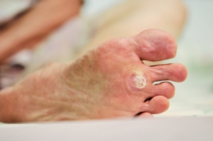 How to Prevent Plantar Warts from Recurring