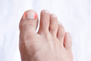 The Development of an Ingrown Toenail