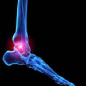 Arthritis and Foot Pain