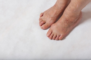 Different Types of Hammertoe