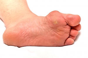 Causes and Symptoms of Bunions