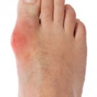 Gout Risk possibly linked to Obesity