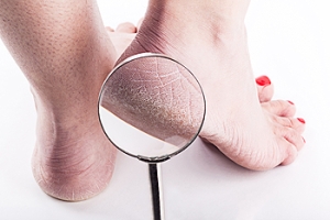 A Lack of Vitamins May Cause Cracked Heels