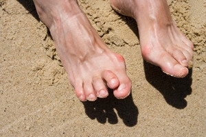 Causes of Hammertoe