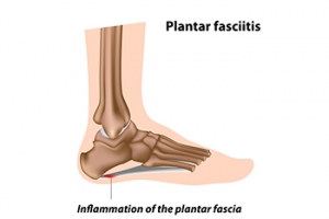 Treating Plantar Fasciitis With Surgery