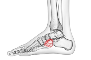 Signs of Cuboid Syndrome