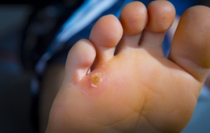 Possible Remedies for Corns on the Feet