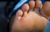 Possible Remedies for Corns on the Feet