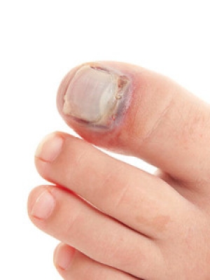 What to Know About a Broken Toe