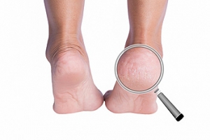 Possible Causes of Cracked Heels